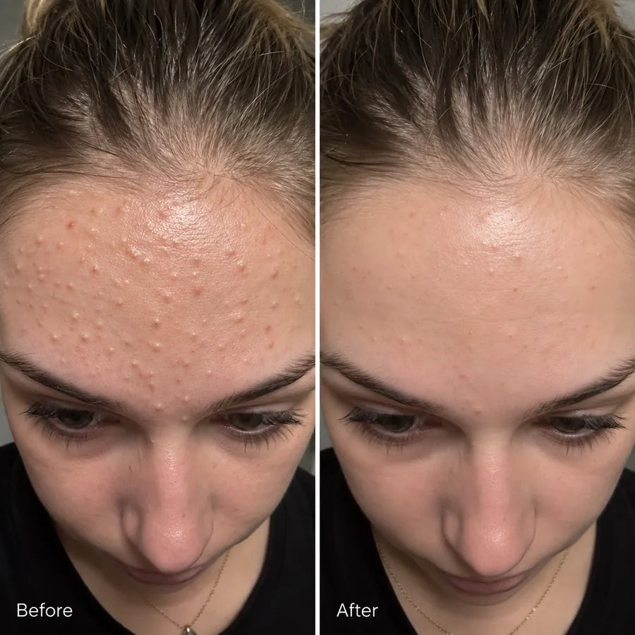 Before and after forehead bumps and texture skincare result
