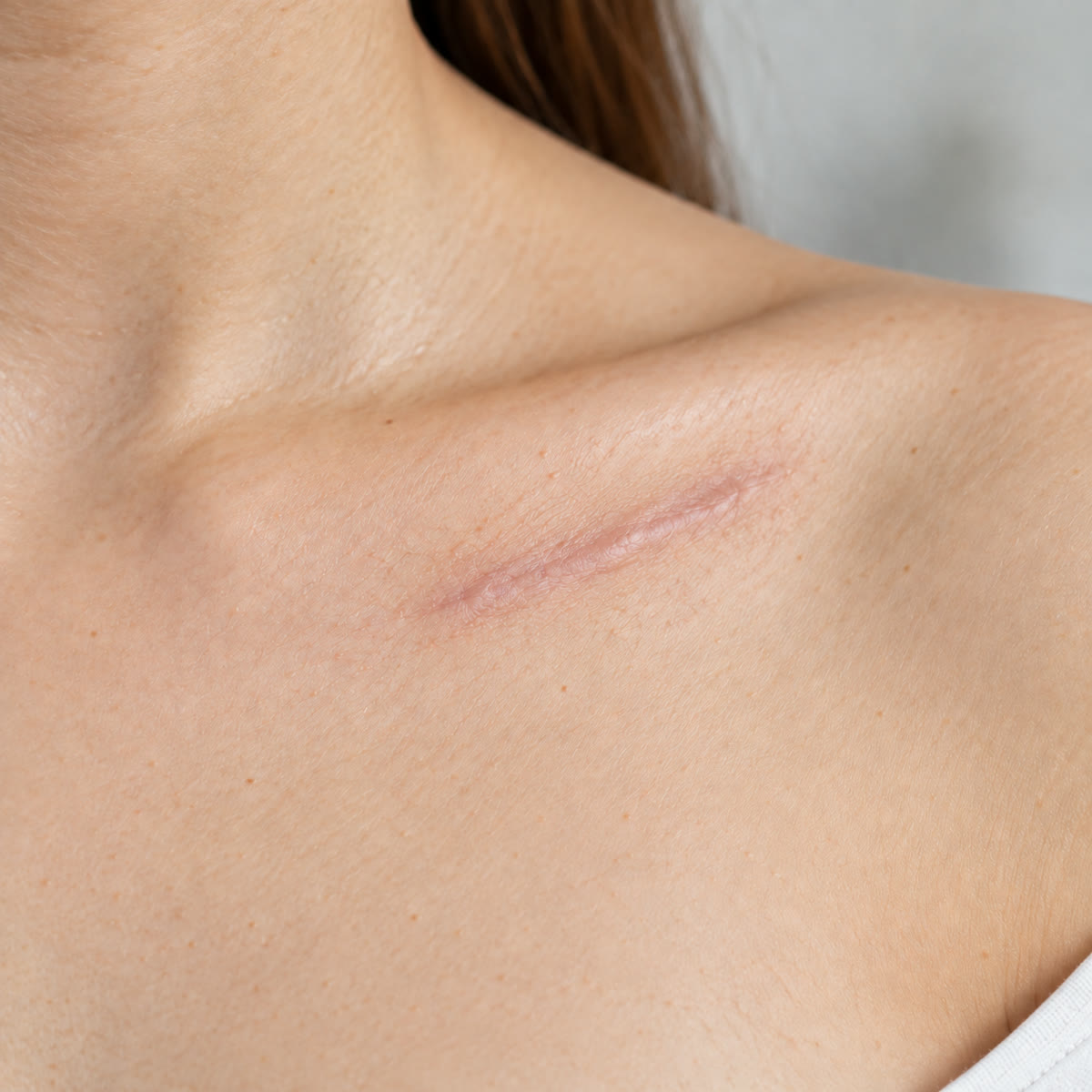 Later view of the same shoulder scar