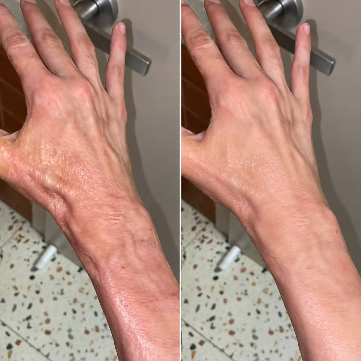 Side-by-side burn scar appearance comparison on a hand and wrist