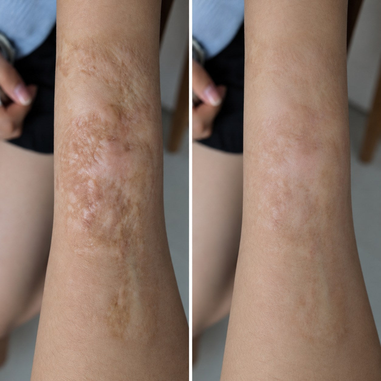 Side-by-side burn scar appearance comparison on a forearm