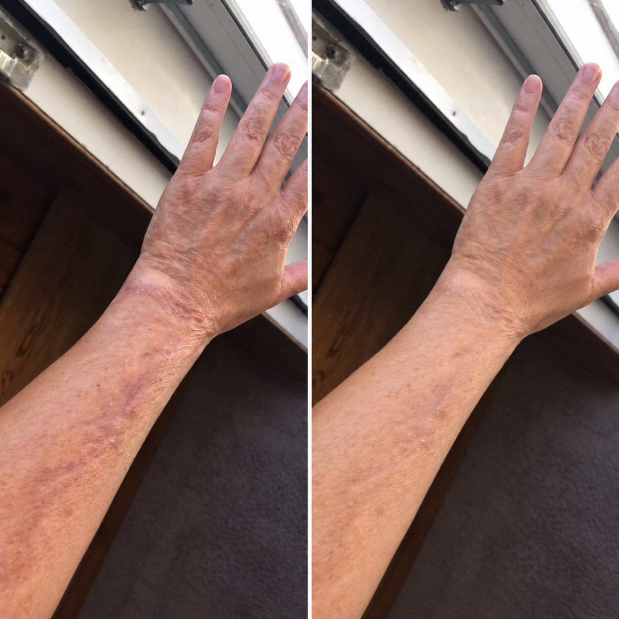 Side-by-side burn scar appearance comparison on a hand and forearm