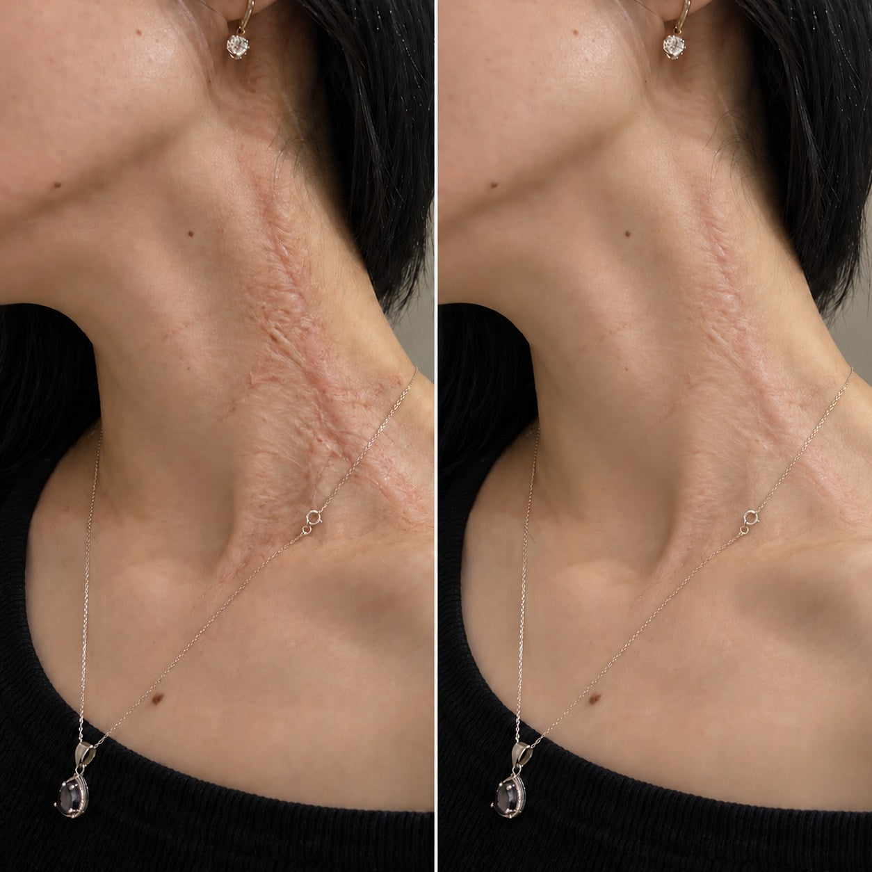 Side-by-side burn scar appearance comparison on the neck and upper chest