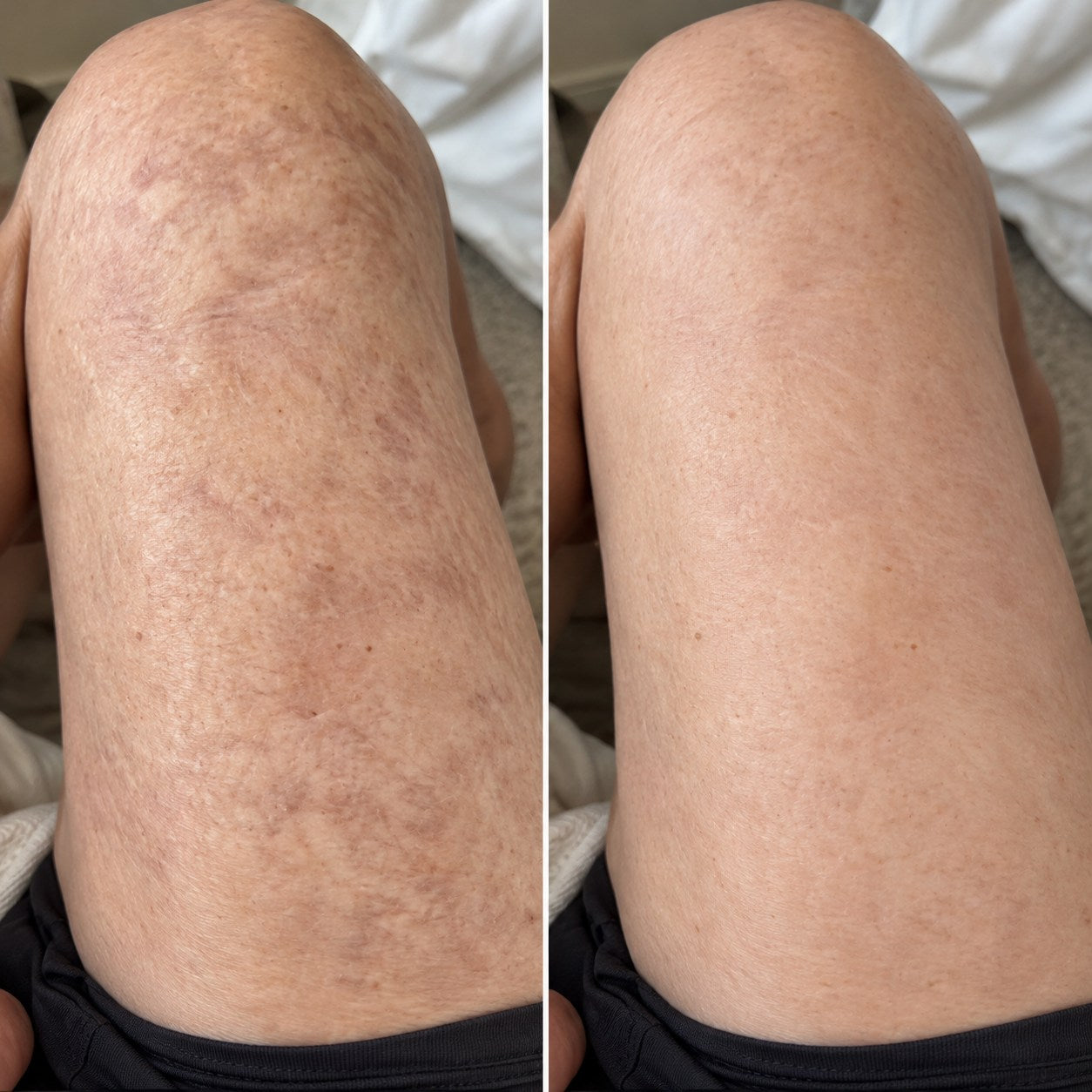 Side-by-side burn scar appearance comparison on a thigh