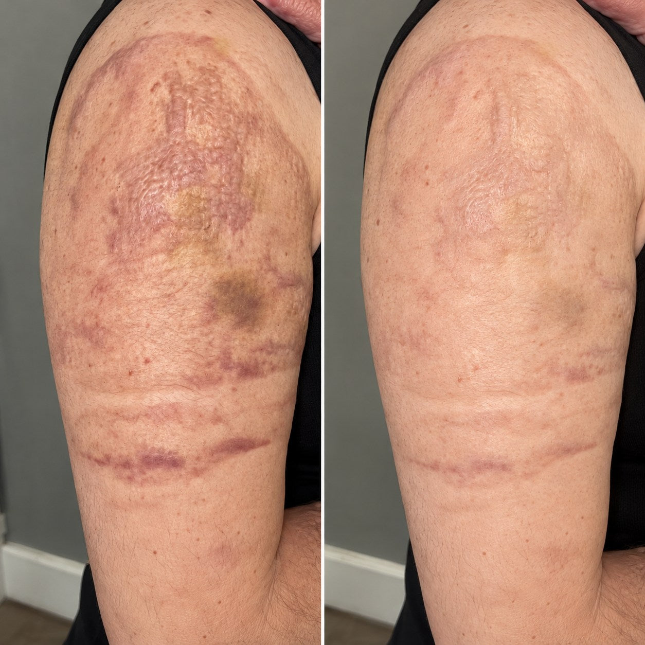 Side-by-side burn scar appearance comparison on an upper arm