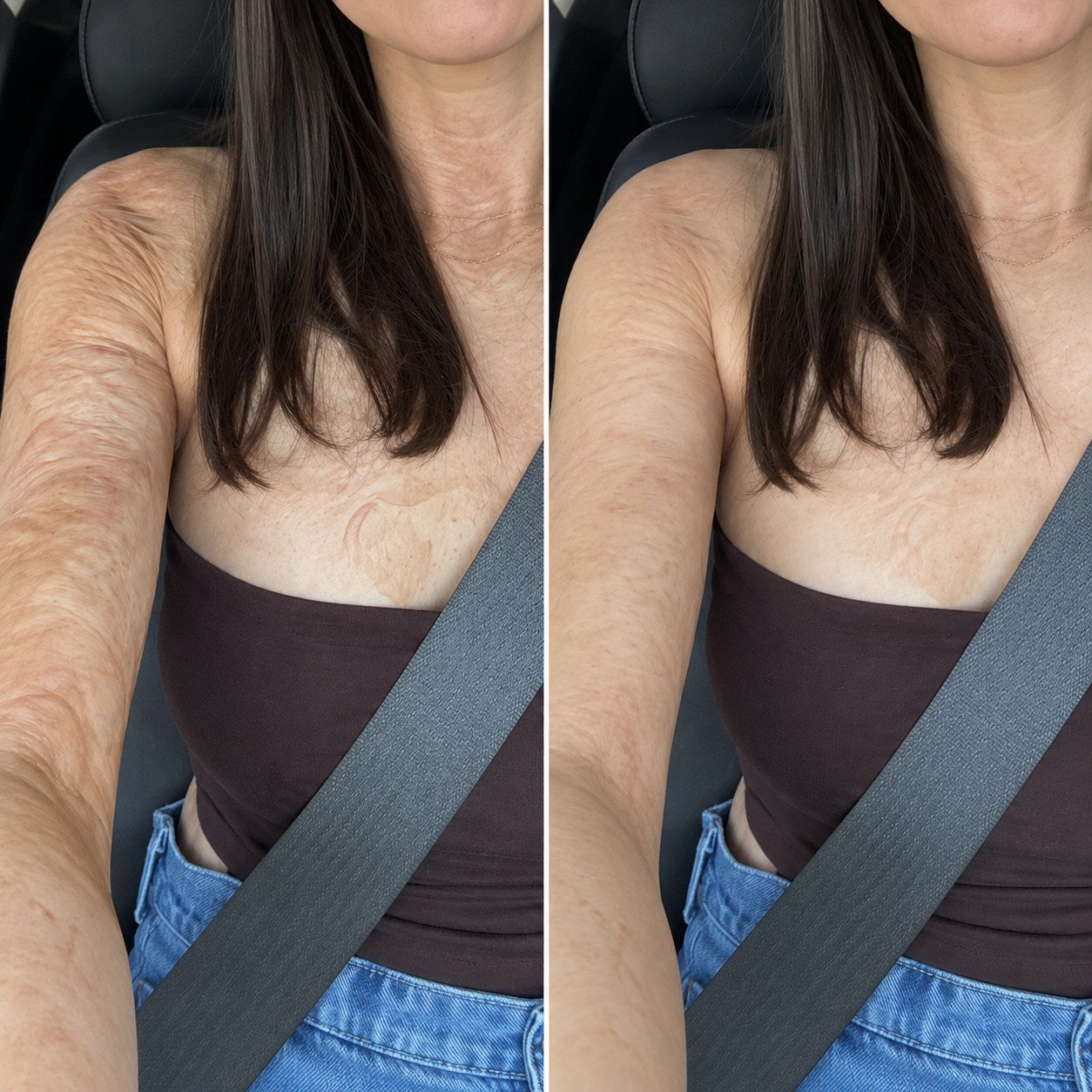 Side-by-side burn scar appearance comparison on an arm and upper chest