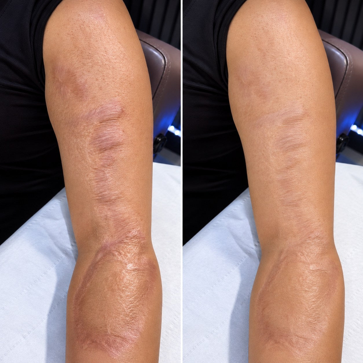 Side-by-side burn scar appearance comparison around an elbow