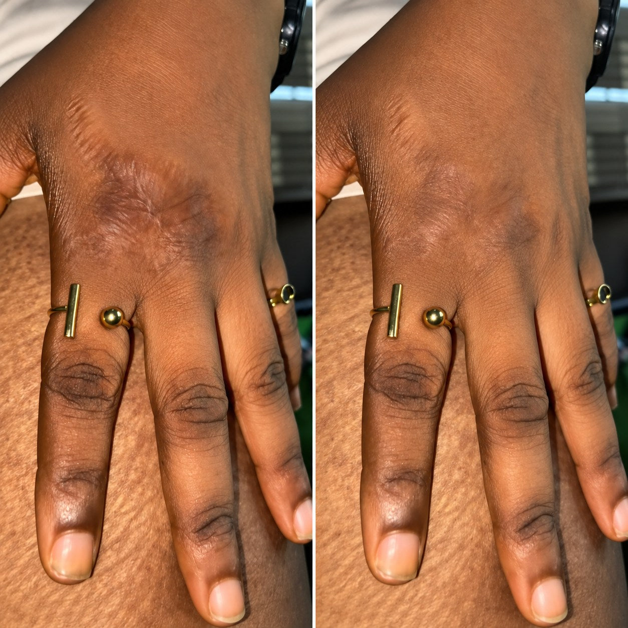 Side-by-side burn scar appearance comparison on a hand