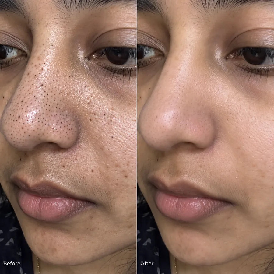 Before and after close-up blackhead skincare result