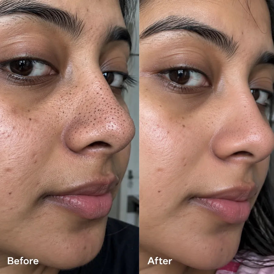 Before and after nose blackhead and pore appearance skincare result