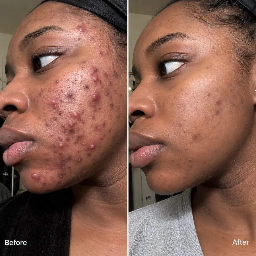 Before and after acne-prone cheek skincare result