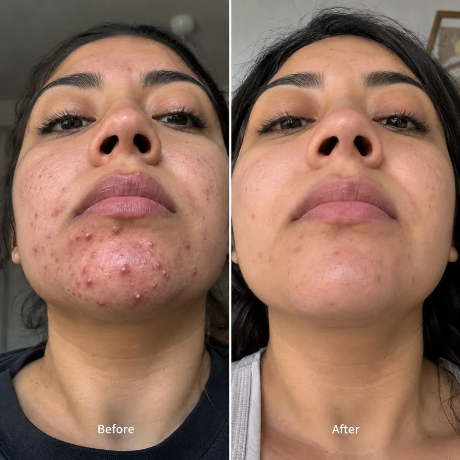 Before and after chin acne skincare result