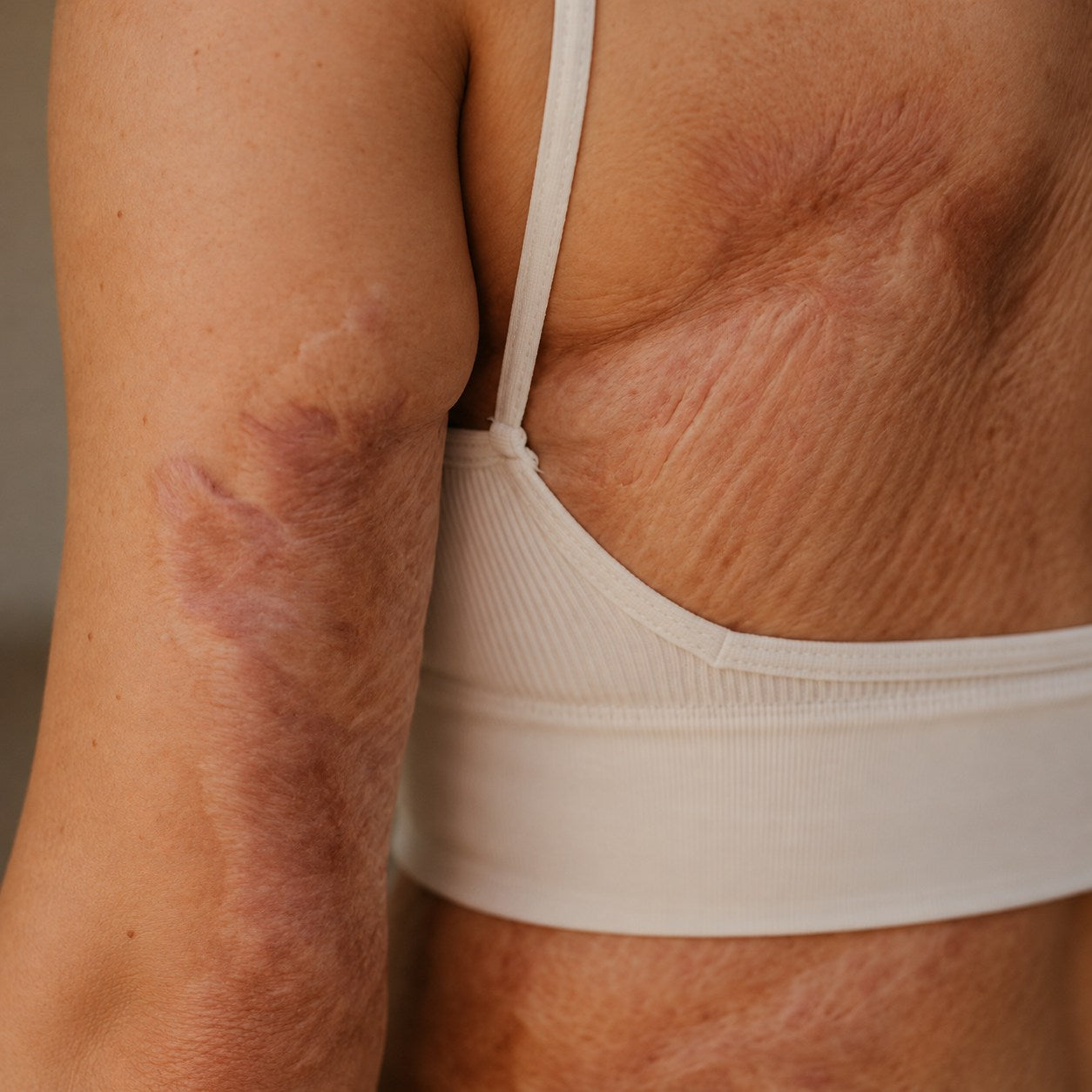 TRILUMIA burn scar care