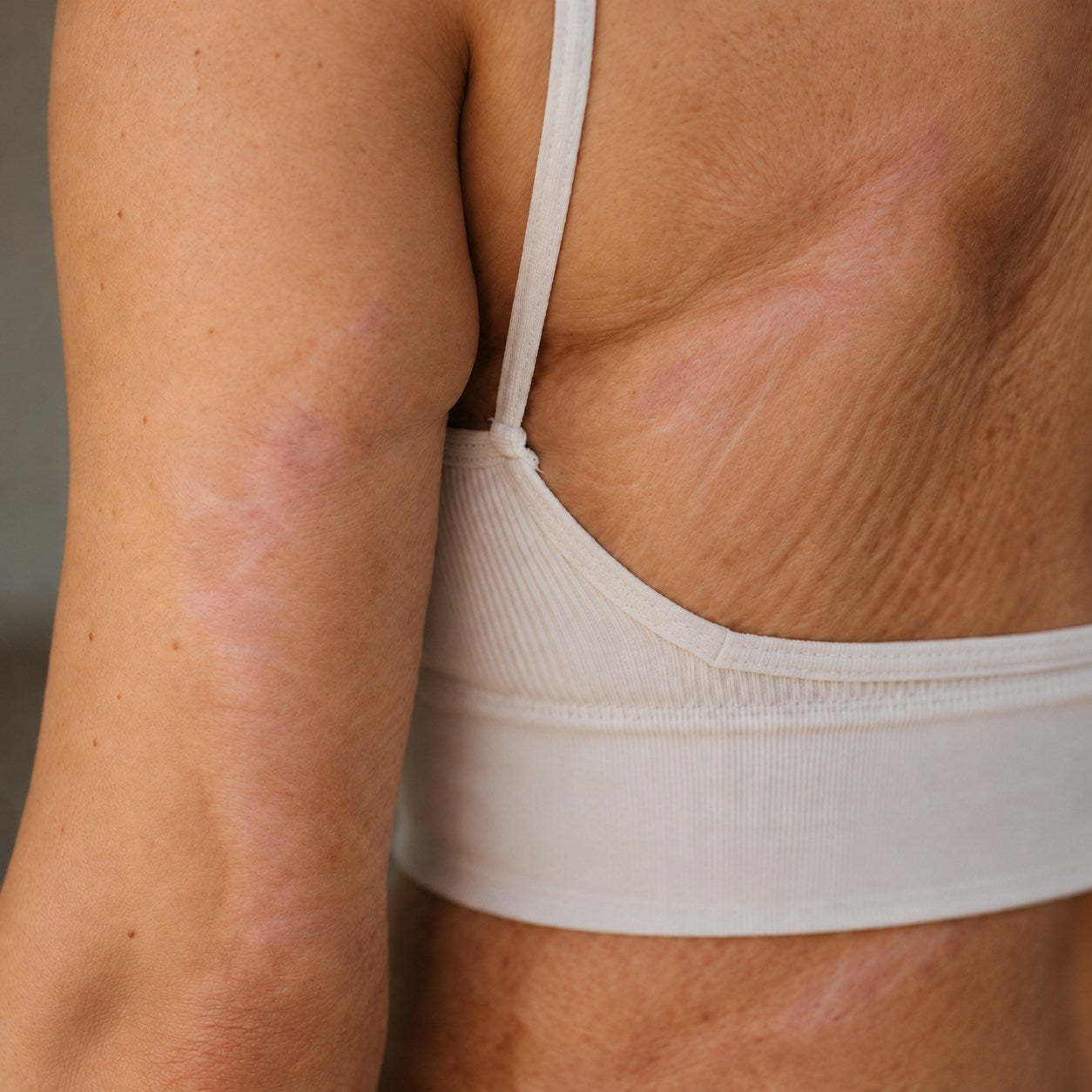 TRILUMIA burn scar care