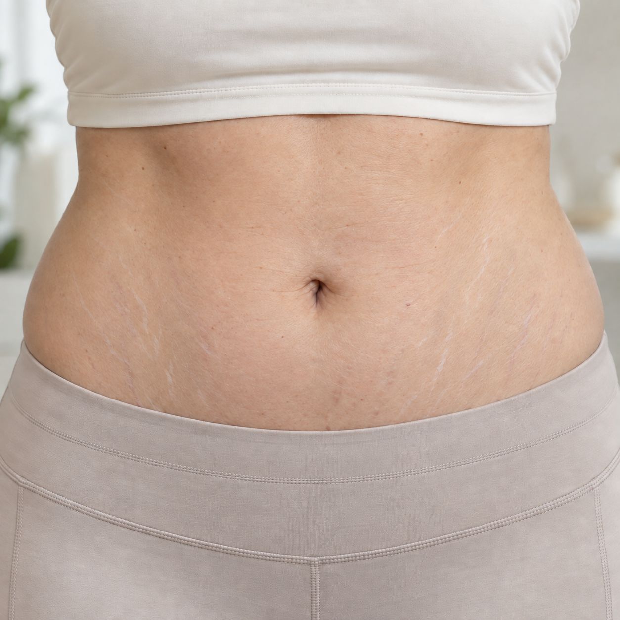 Abdominal stretch-mark appearance in a later routine record