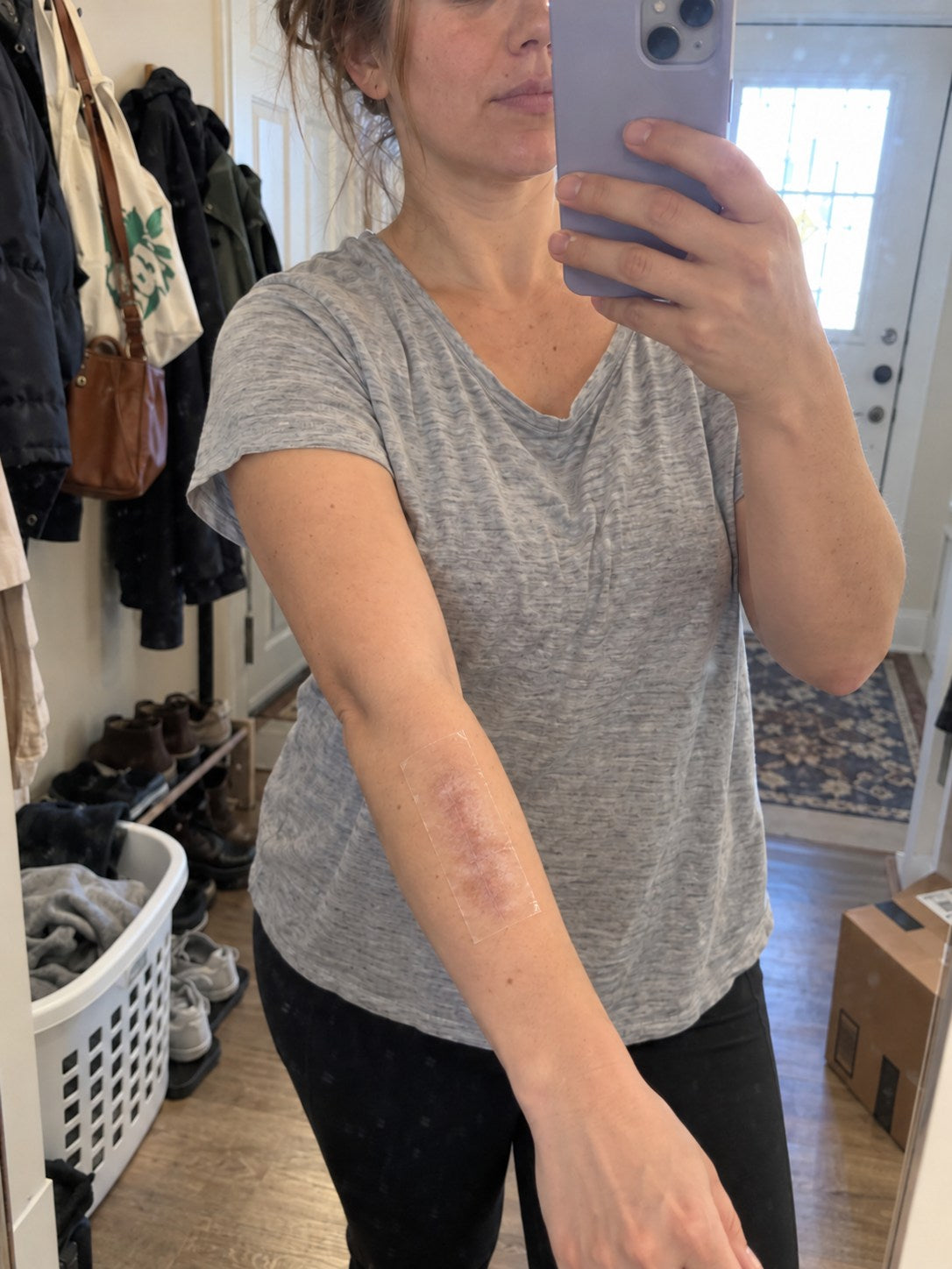TRILUMIA burn scar care