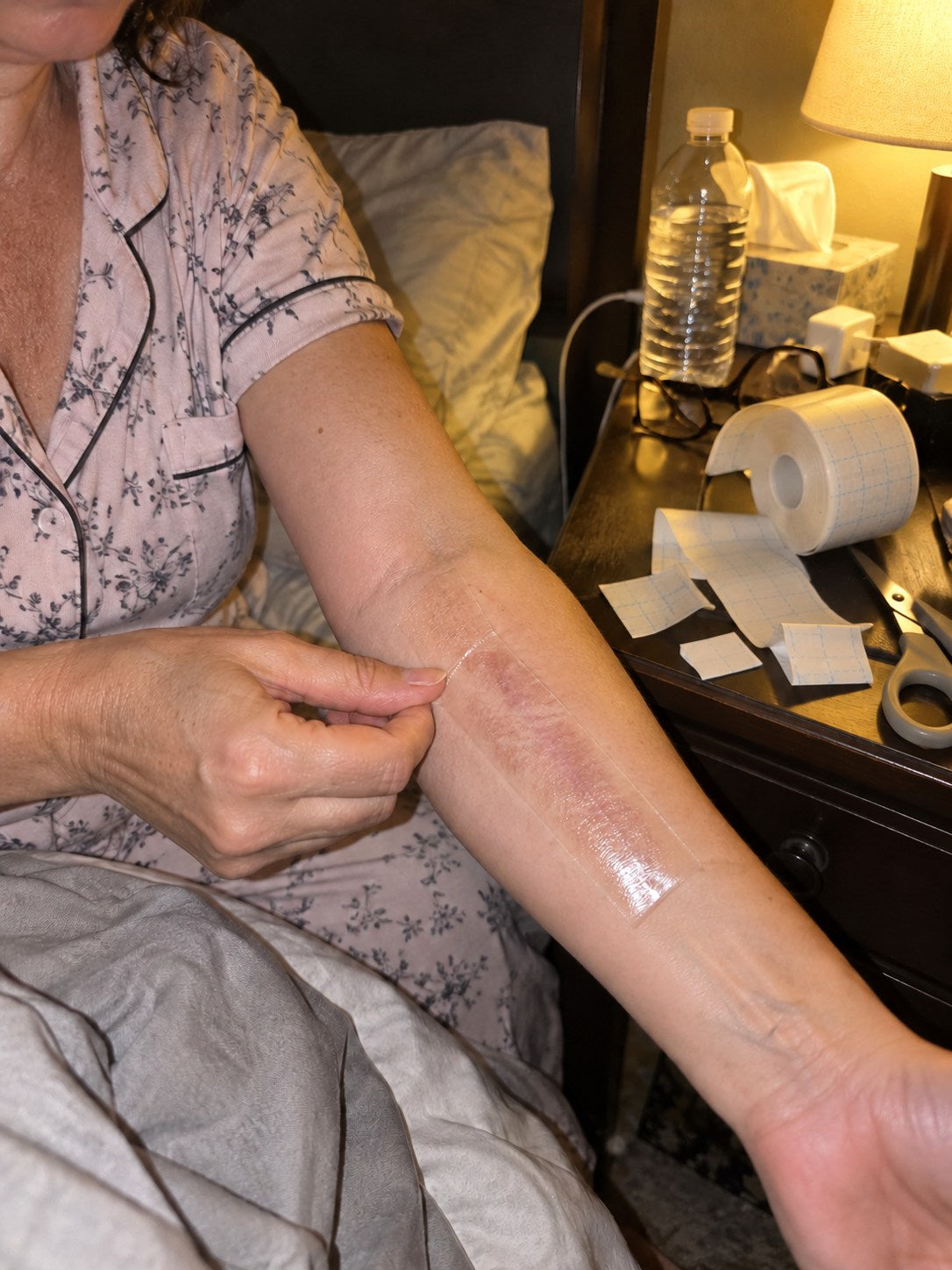 TRILUMIA burn scar care