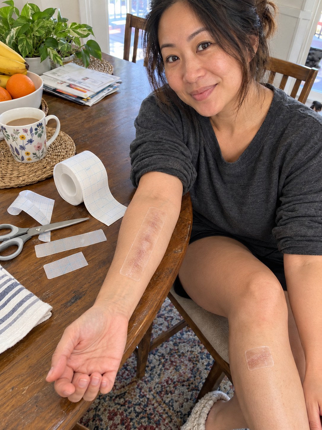 TRILUMIA burn scar care