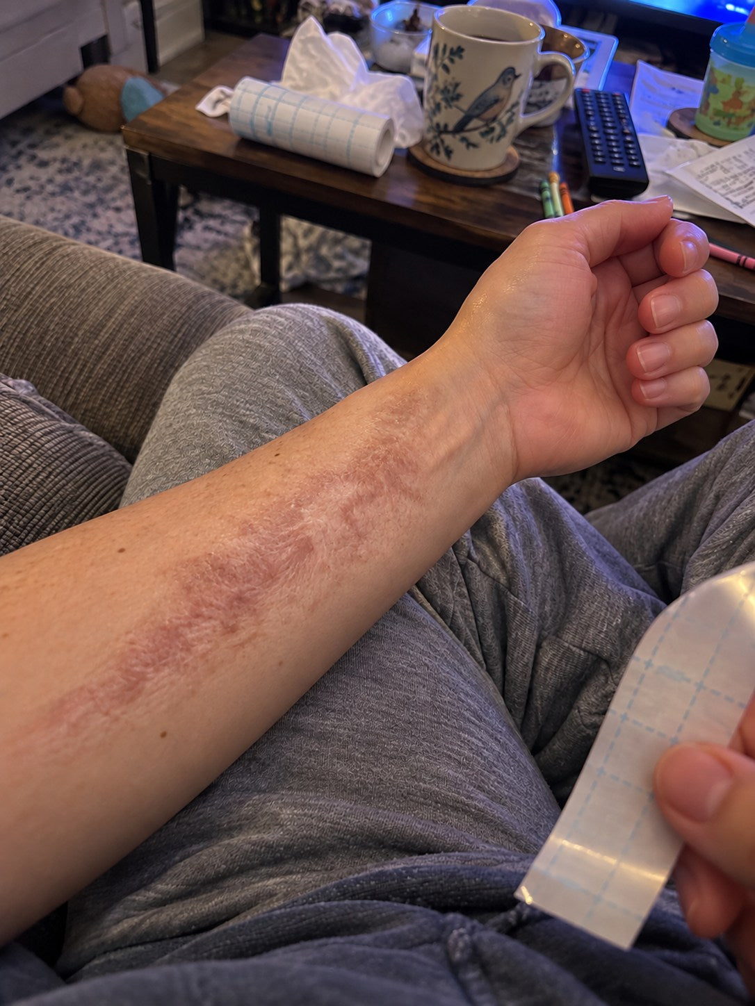 TRILUMIA burn scar care