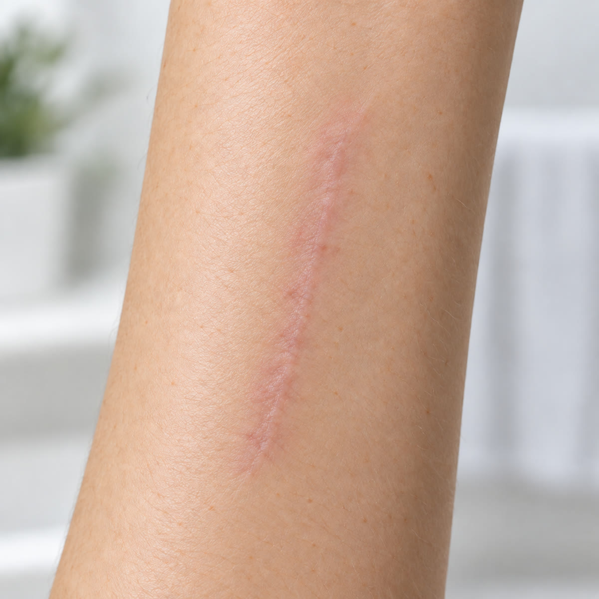 Later view of the same linear arm scar