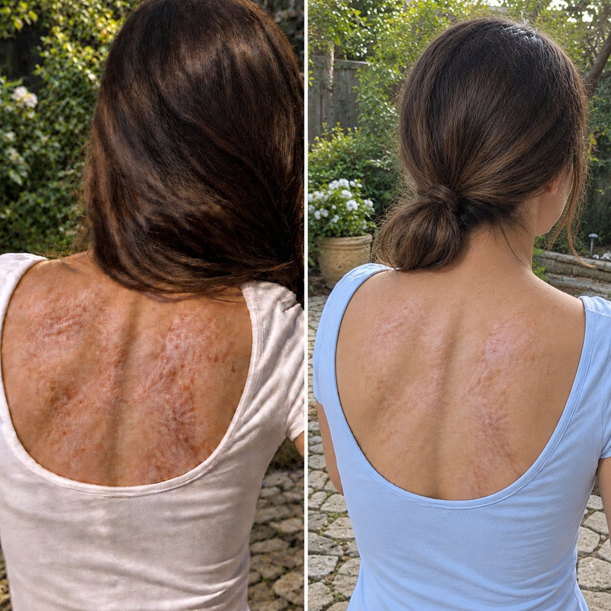 TRILUMIA burn scar care