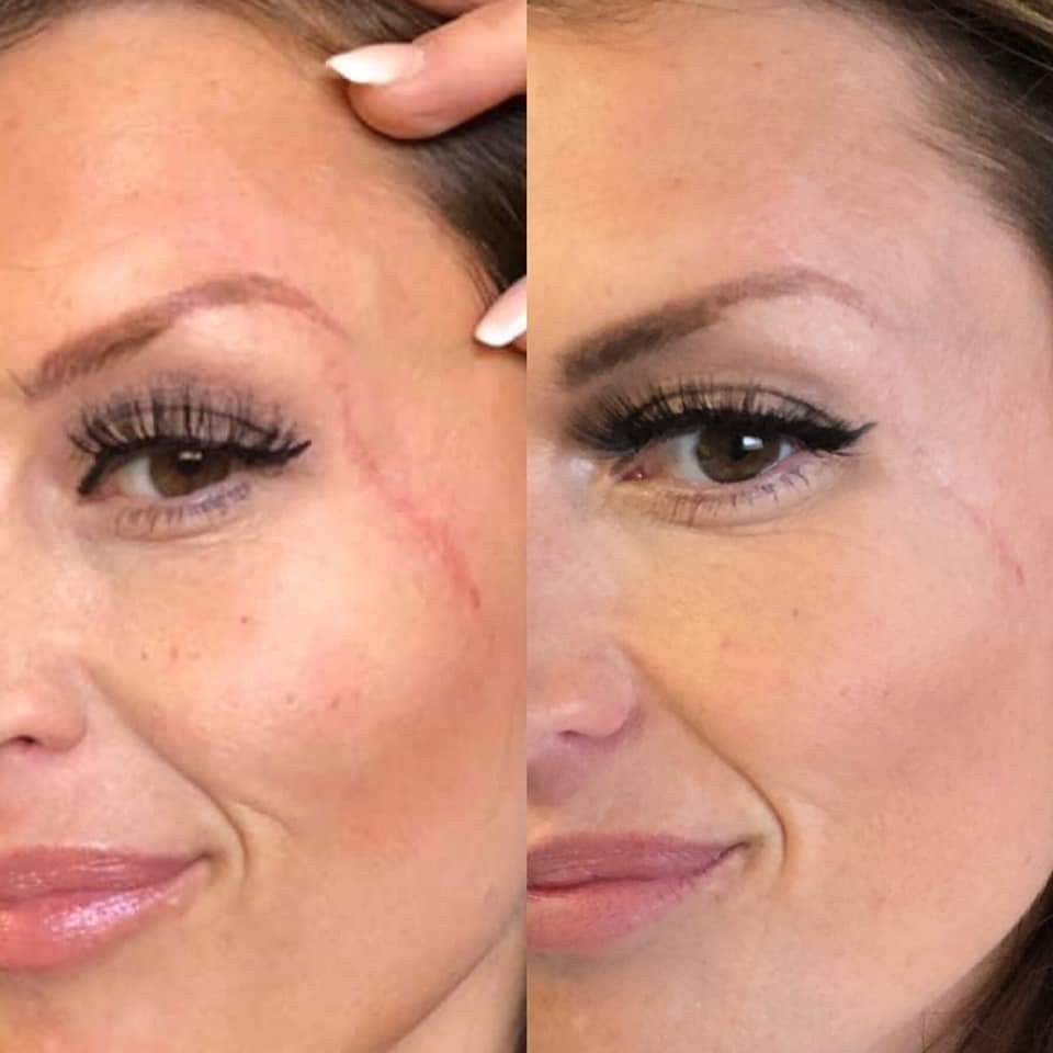 Scar comparison example 4