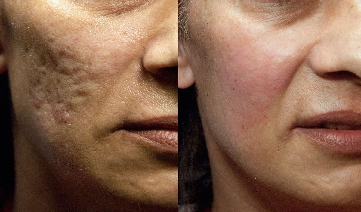 Scar comparison example 5