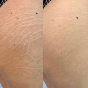 Scar comparison example 8