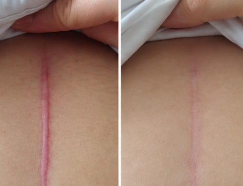 Scar comparison example 10