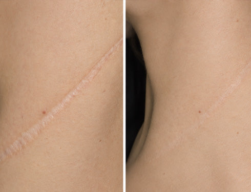 Scar comparison example 15