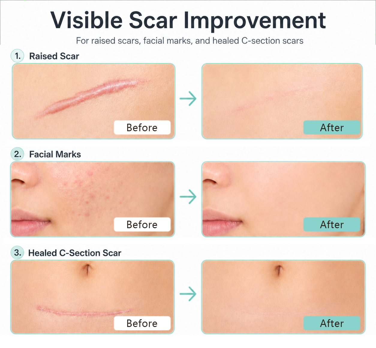Visible scar improvement examples for raised scars, facial marks, and healed C-section scars